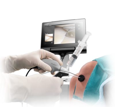 Arthroskopie am Knie – Hochinnovative Technik des Nanoskop Arthroskopie am Knie - Hochinnovative Technik des Nanoskop
