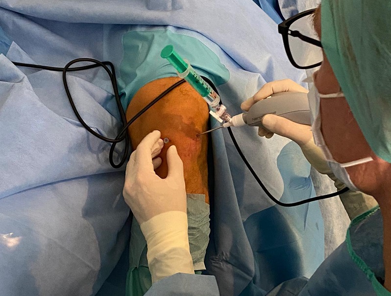 Operative Therapie - Nanoskopie
